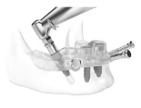Guided Surgery